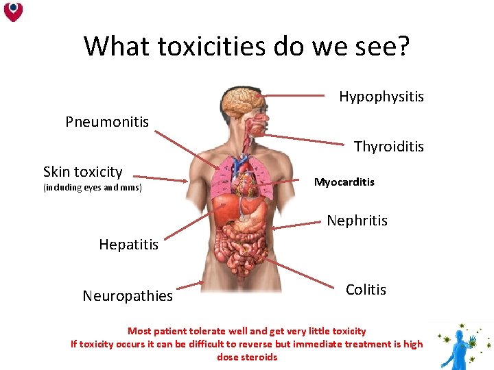 What toxicities do we see? Hypophysitis Pneumonitis Thyroiditis Skin toxicity (including eyes and mms) What toxicities do we see? Hypophysitis Pneumonitis Thyroiditis Skin toxicity (including eyes and mms)