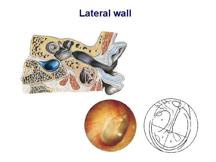 Lateral wall 