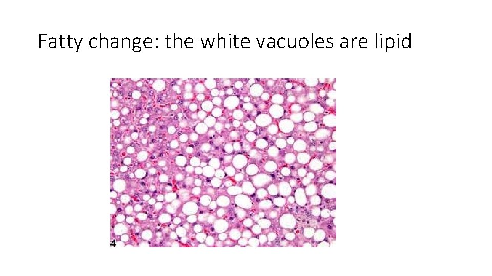 Fatty change: the white vacuoles are lipid 