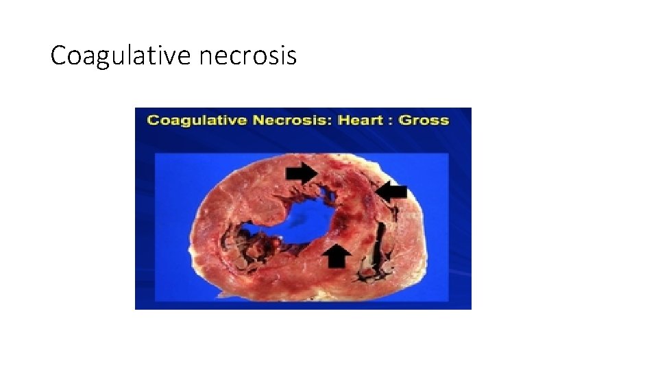 Coagulative necrosis 
