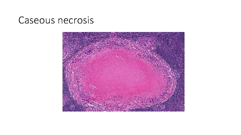 Caseous necrosis 