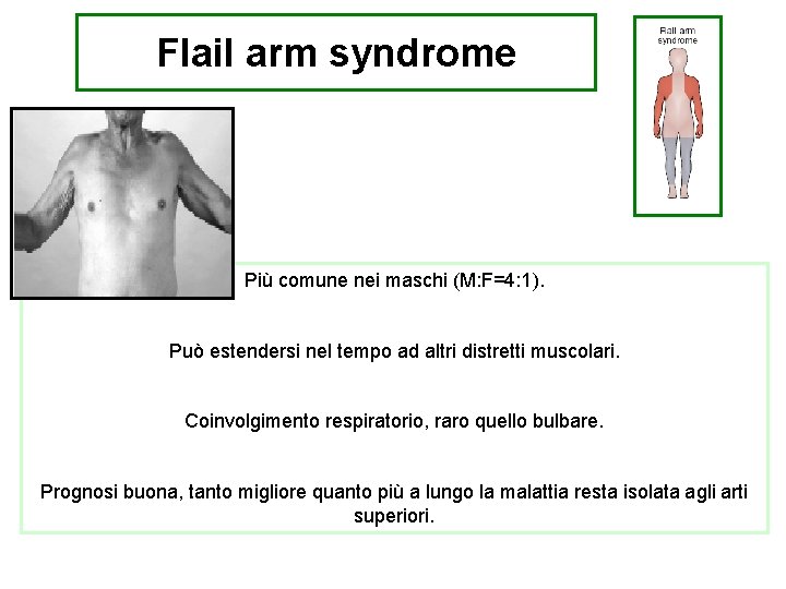 Flail arm syndrome Più comuneipostenia nei maschi (M: F=4: 1). Colpisce gli ARTI SUPERIORI: