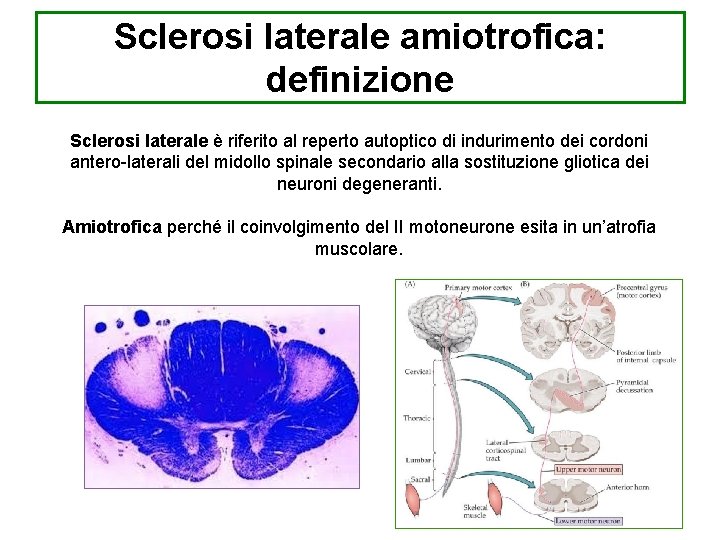Sclerosi laterale amiotrofica: definizione Sclerosi laterale è riferito al reperto autoptico di indurimento dei