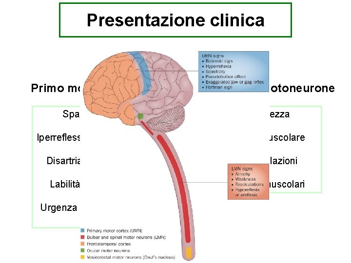 Presentazione clinica Combinazione di segni di compromissione del Primo motoneurone Secondo motoneurone Spasticità Debolezza