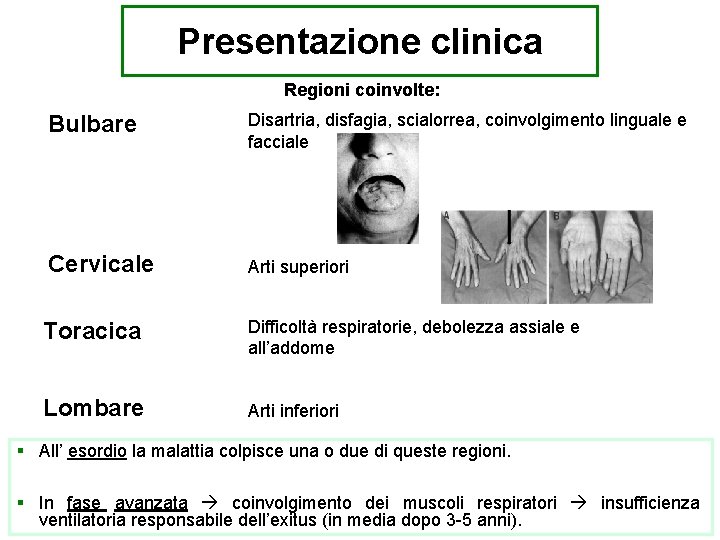 Presentazione clinica Regioni coinvolte: Bulbare Disartria, disfagia, scialorrea, coinvolgimento linguale e facciale Cervicale Arti
