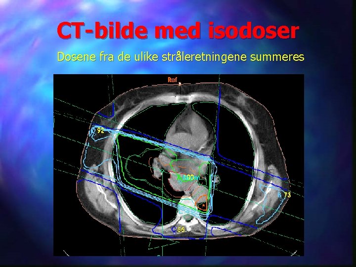 CT-bilde med isodoser Dosene fra de ulike stråleretningene summeres Ett av de scannede bildene