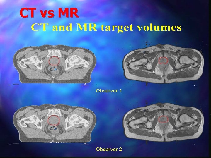 CT vs MR 