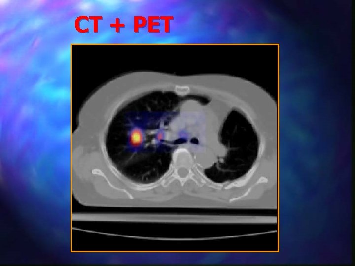 CT + PET 