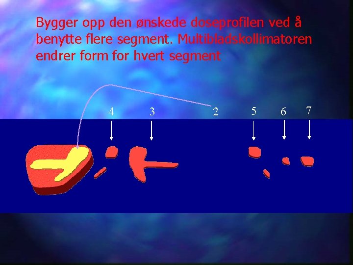 Bygger opp den ønskede doseprofilen ved å benytte flere segment. Multibladskollimatoren endrer form for