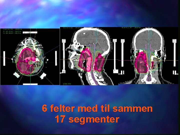 6 felter med til sammen 17 segmenter 