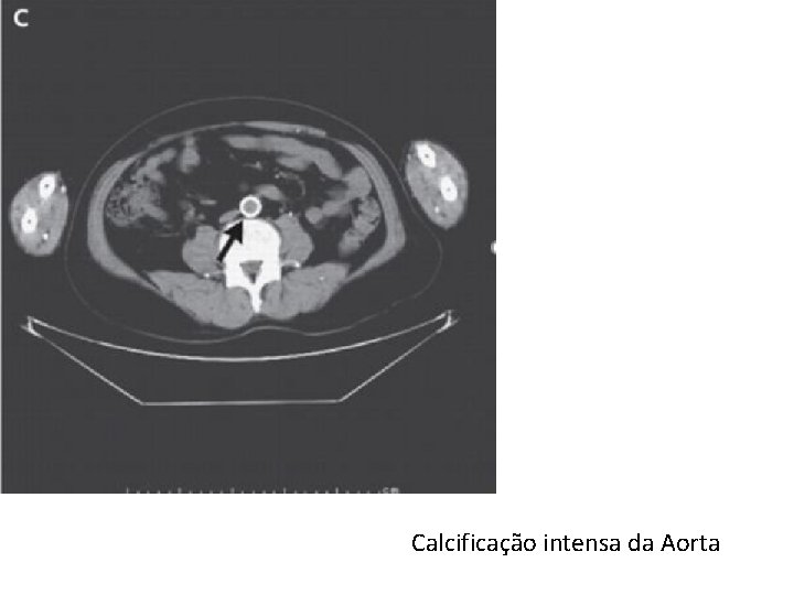 Calcificação intensa da Aorta 