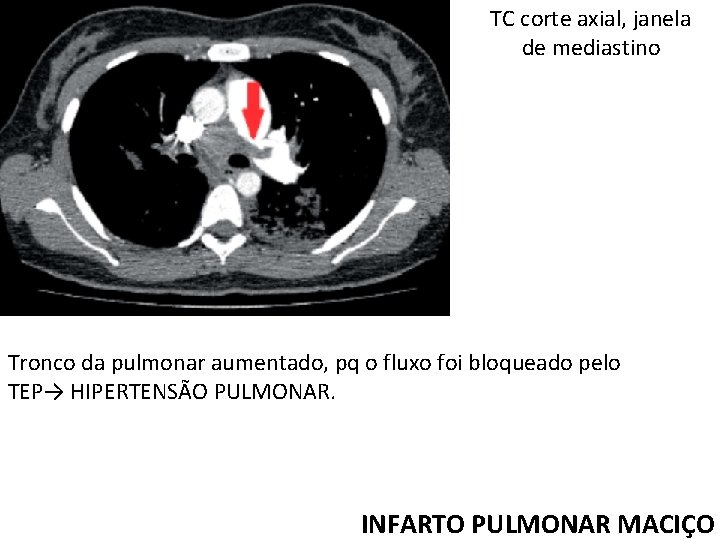 TC corte axial, janela de mediastino Tronco da pulmonar aumentado, pq o fluxo foi