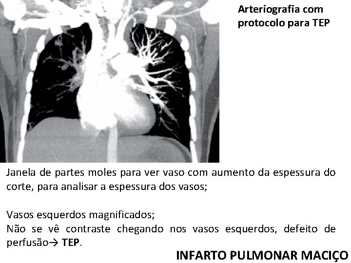 Arteriografia com protocolo para TEP Janela de partes moles para ver vaso com aumento