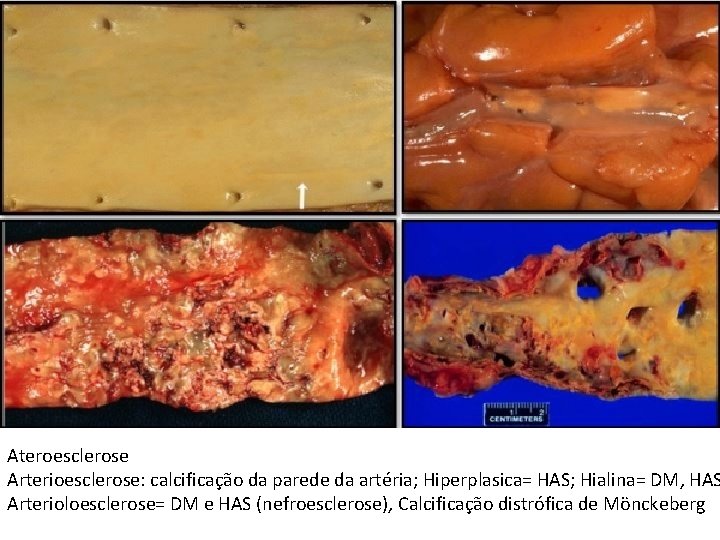 Ateroesclerose Arterioesclerose: calcificação da parede da artéria; Hiperplasica= HAS; Hialina= DM, HAS Arterioloesclerose= DM