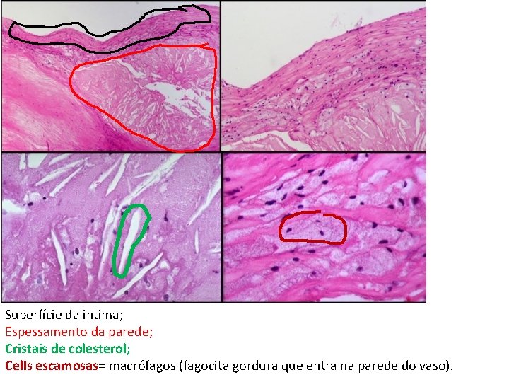 Superfície da intima; Espessamento da parede; Cristais de colesterol; Cells escamosas= macrófagos (fagocita gordura