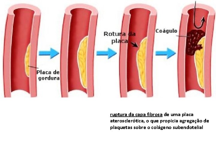ruptura da capa fibrosa de uma placa aterosclerótica, o que propicia agregação de plaquetas