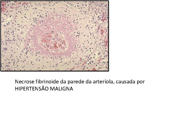 Necrose fibrinoide da parede da arteríola, causada por HIPERTENSÃO MALIGNA 