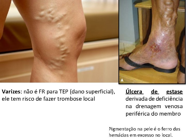 Varizes: não é FR para TEP (dano superficial), ele tem risco de fazer trombose