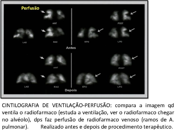 Perfusão CINTILOGRAFIA DE VENTILAÇÃO-PERFUSÃO: compara a imagem qd ventila o radiofarmaco (estuda a ventilação,