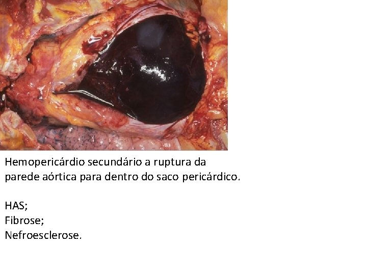 Hemopericárdio secundário a ruptura da parede aórtica para dentro do saco pericárdico. HAS; Fibrose;