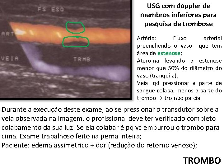 USG com doppler de membros inferiores para pesquisa de trombose Artéria: Fluxo arterial preenchendo