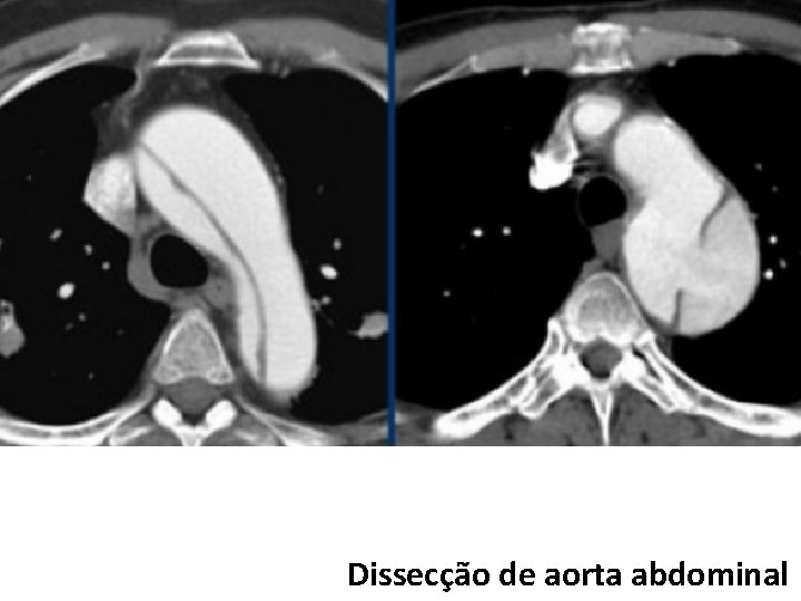 Dissecção de aorta abdominal 