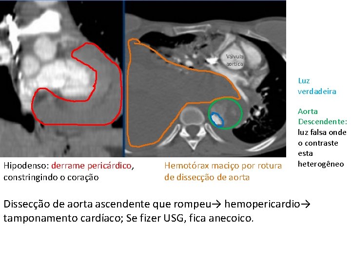 Válvula aortica Luz verdadeira Hipodenso: derrame pericárdico, constringindo o coração Hemotórax maciço por rotura