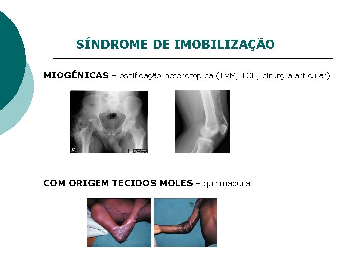 SÍNDROME DE IMOBILIZAÇÃO MIOGÉNICAS – ossificação heterotópica (TVM, TCE, cirurgia articular) COM ORIGEM TECIDOS
