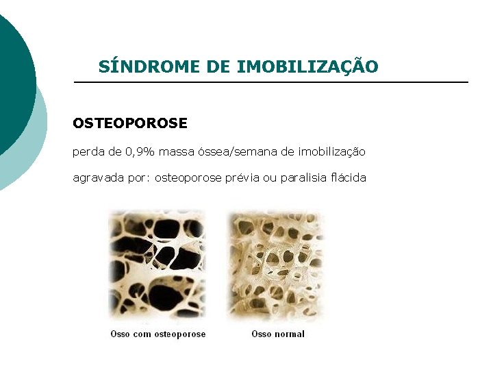 SÍNDROME DE IMOBILIZAÇÃO OSTEOPOROSE perda de 0, 9% massa óssea/semana de imobilização agravada por: