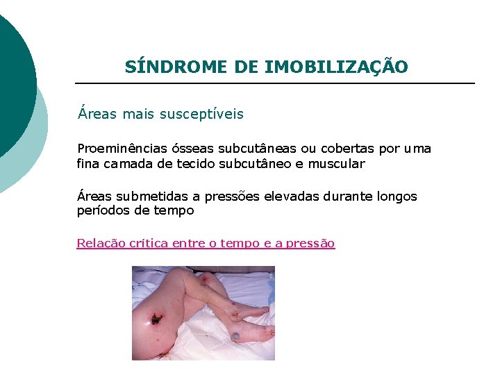 SÍNDROME DE IMOBILIZAÇÃO Áreas mais susceptíveis Proeminências ósseas subcutâneas ou cobertas por uma fina