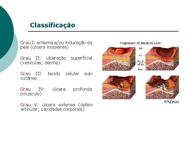 Classificação Grau I: eritema e/ou induração da pele (úlcera incipiente) Grau II: ulceração II