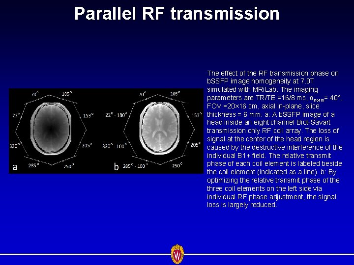 Parallel RF transmission The effect of the RF transmission phase on b. SSFP image
