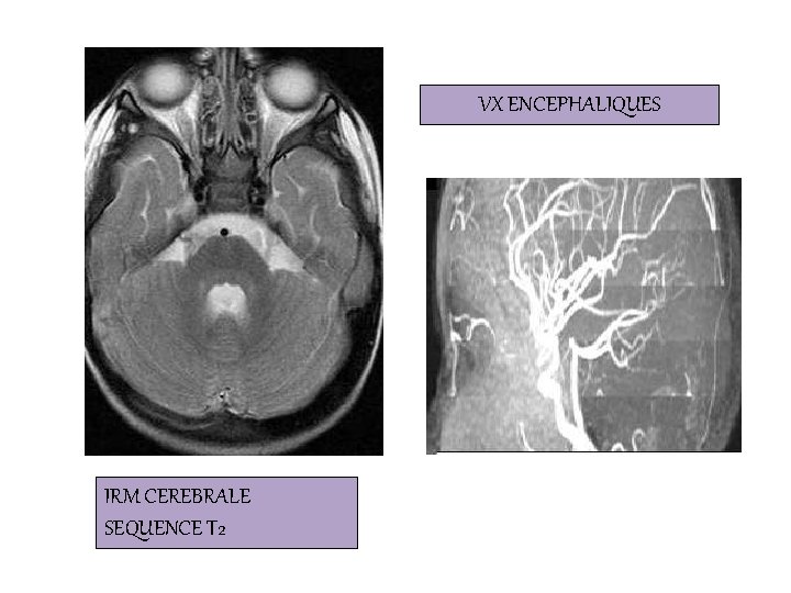 VX ENCEPHALIQUES IRM CEREBRALE SEQUENCE T 2 