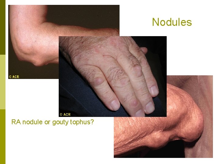 Nodules RA nodule or gouty tophus? 