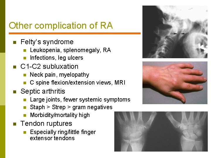 Other complication of RA n Felty’s syndrome n n n C 1 -C 2