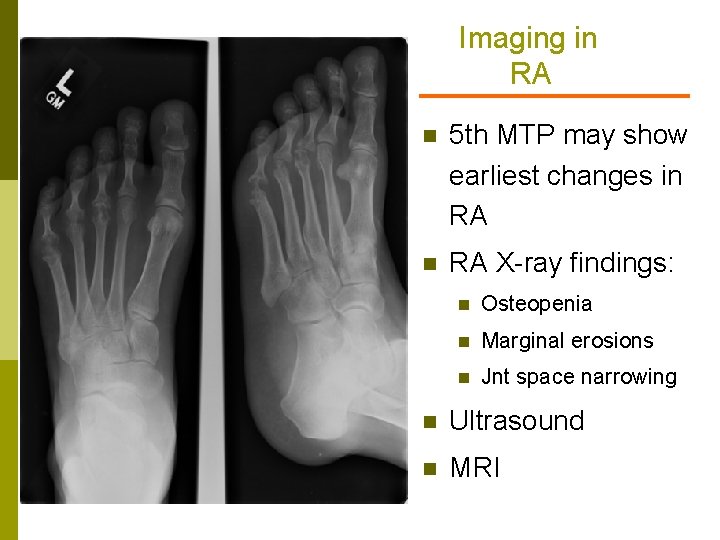 Imaging in RA n 5 th MTP may show earliest changes in RA X-ray