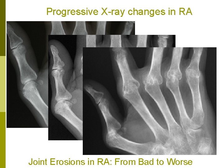 Progressive X-ray changes in RA Joint Erosions in RA: From Bad to Worse 