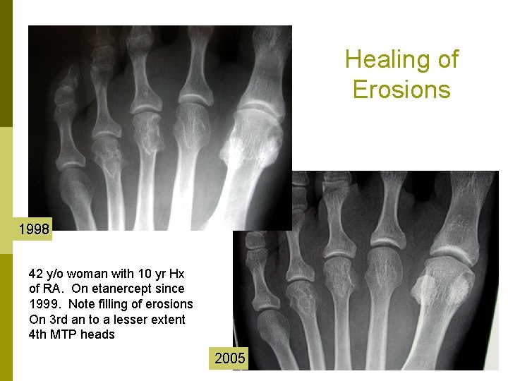 Healing of Erosions 1998 42 y/o woman with 10 yr Hx of RA. On