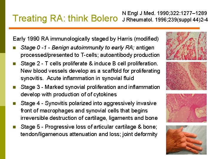 Treating RA: think Bolero N Engl J Med. 1990; 322: 1277– 1289 J Rheumatol.