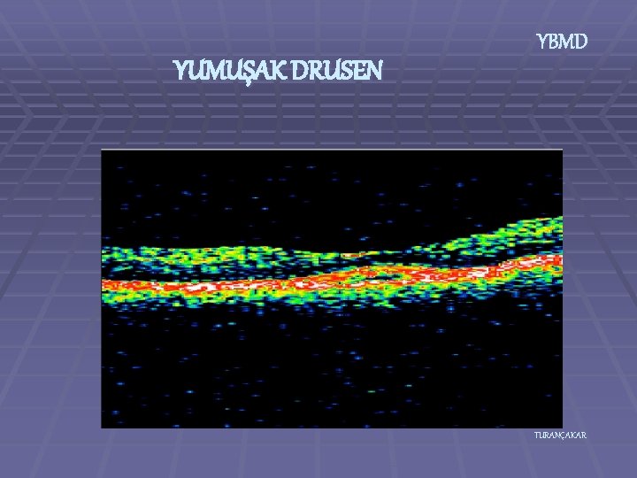 YUMUŞAK DRUSEN YBMD TURANÇAKAR 