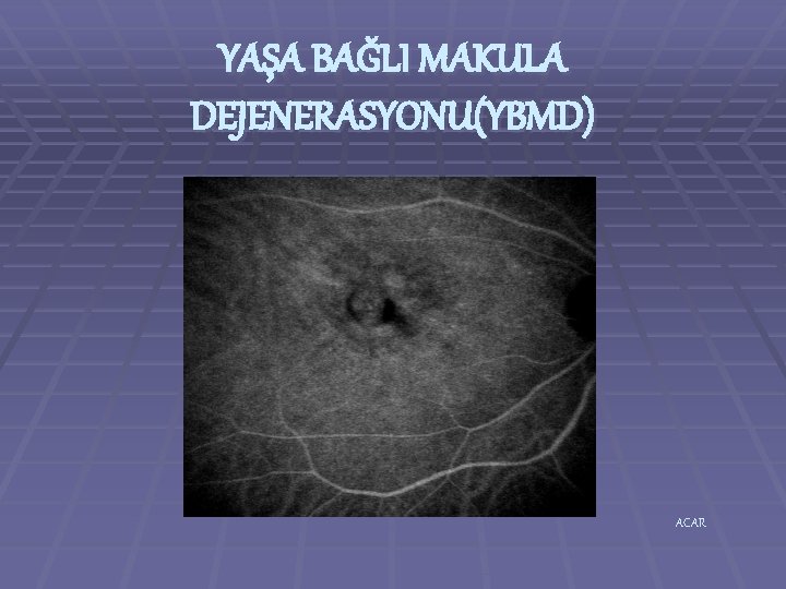 YAŞA BAĞLI MAKULA DEJENERASYONU(YBMD) ACAR 