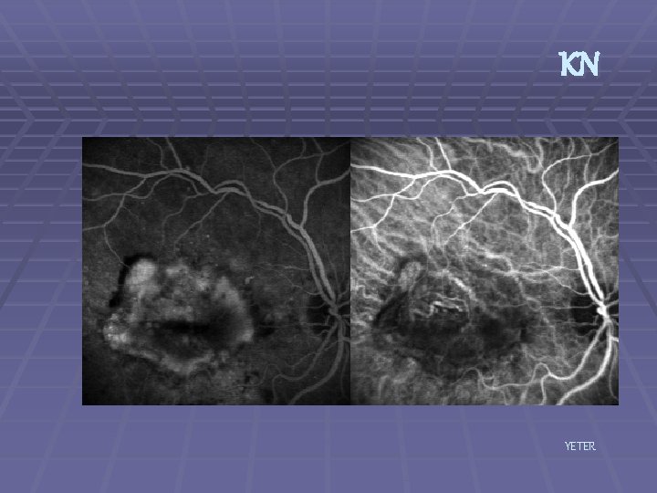 KN YETER 