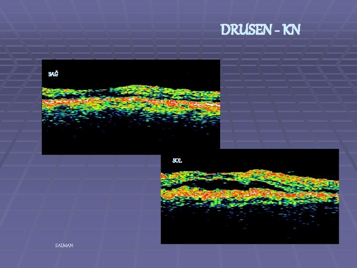 DRUSEN - KN SAĞ SOL SALMAN 