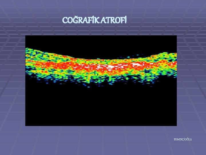 COĞRAFİK ATROFİ EKMEKÇİOĞLU 