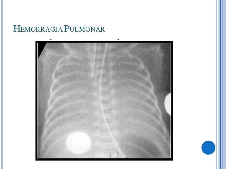 HEMORRAGIA PULMONAR 