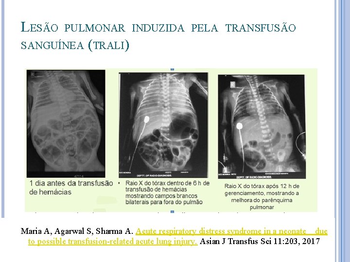 LESÃO PULMONAR INDUZIDA PELA TRANSFUSÃO SANGUÍNEA (TRALI) Maria A, Agarwal S, Sharma A. Acute