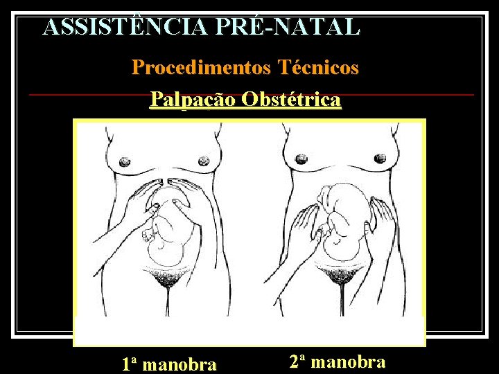 ASSISTÊNCIA PRÉ-NATAL Procedimentos Técnicos Palpação Obstétrica 1ª manobra 2ª manobra 