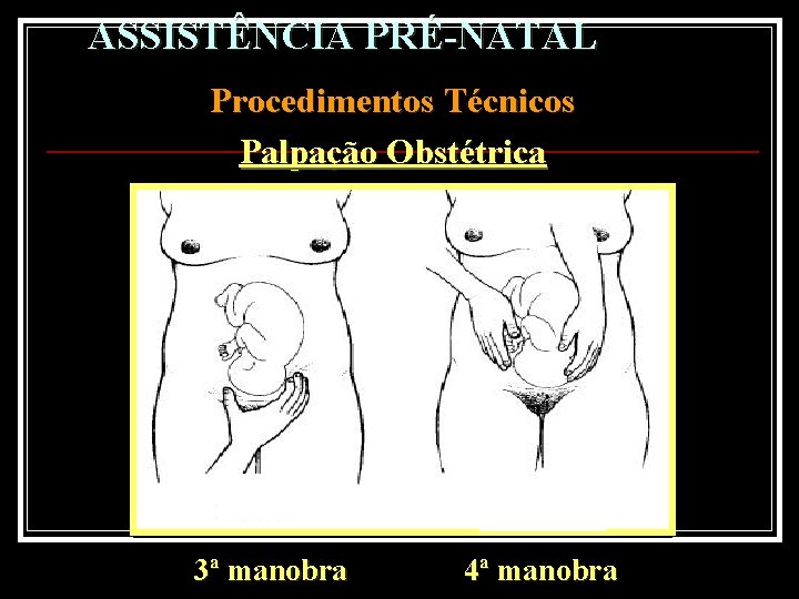 ASSISTÊNCIA PRÉ-NATAL Procedimentos Técnicos Palpação Obstétrica 3ª manobra 4ª manobra 