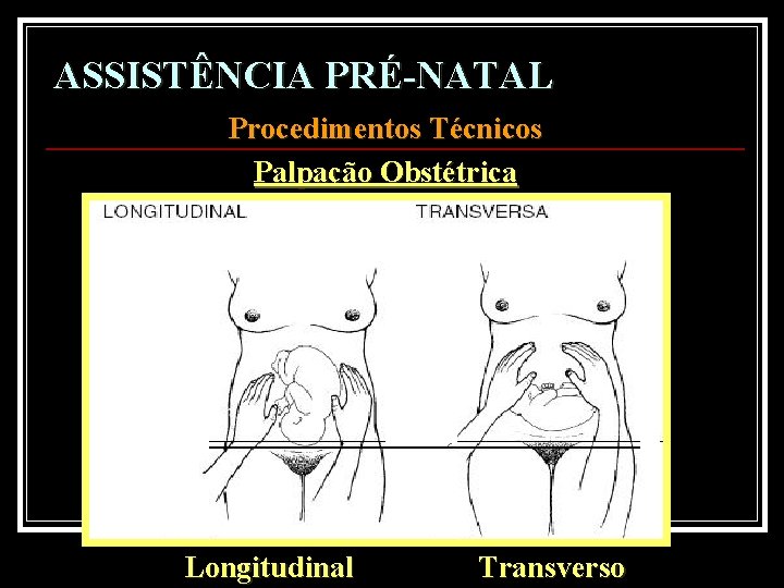 ASSISTÊNCIA PRÉ-NATAL Procedimentos Técnicos Palpação Obstétrica Longitudinal Transverso 