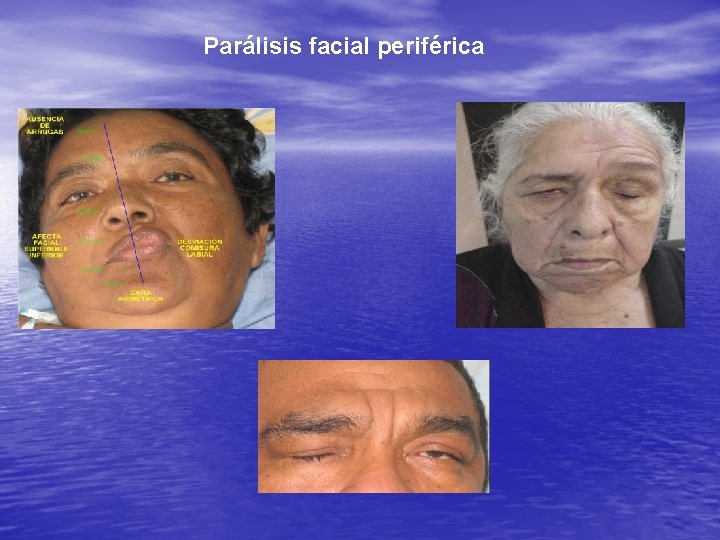  Parálisis facial periférica 